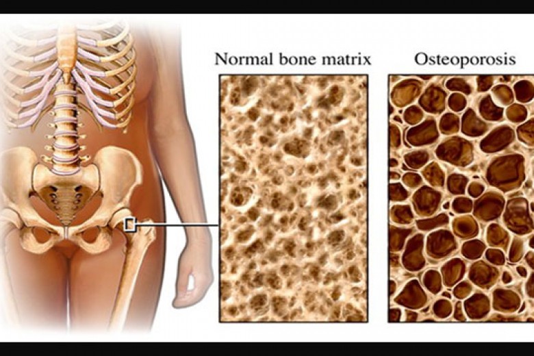 Cegah Osteoporosis Sejak Dini