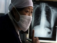 Jumlah Pasien TB di Indonesia Mengkhawatirkan